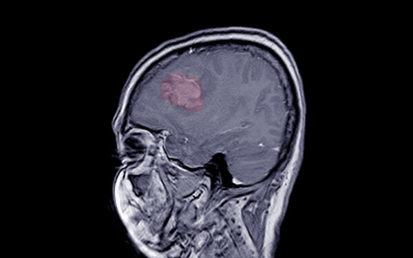 Alert: Common Meds Linked to Brain Tumor