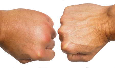 45712756-comparing-swollen-male-caucasian-hands-isolated-towards-white-background.jpg