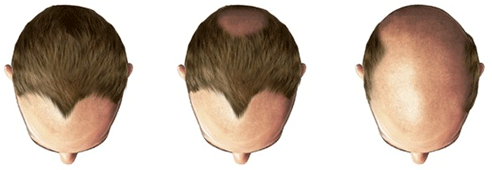 Traits_male_baldness_fig2.gif