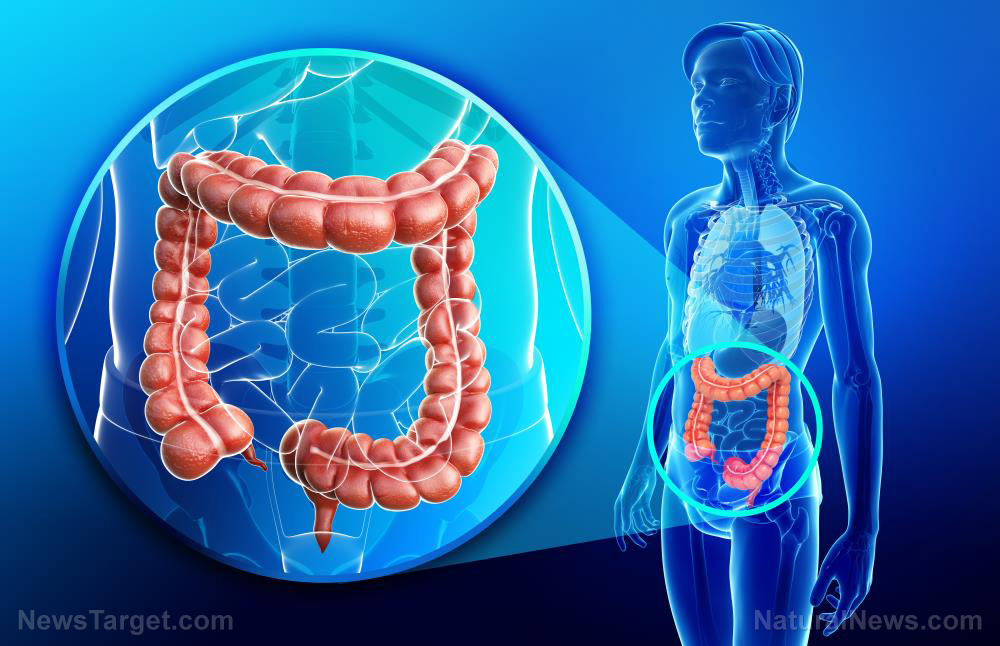 Colon cancer on the rise in young adults: GMOs, vaccines and synthetic folic acid all to blame  